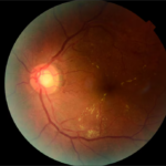 retina
